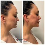 Before and after threads lifting result at CE International Hospital, visible facial contour lift