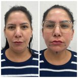 Before and after threads lifting results at CE International Hospital, facial contour improvement