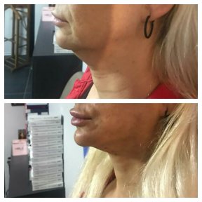 Before and after threads lifting at CE International Hospital, visible jawline tightening result