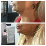 Before and after threads lifting at CE International Hospital, visible jawline tightening result