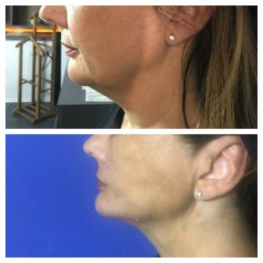 Before and after threads lifting at CE International Hospital, visible jawline tightening result