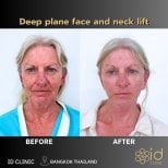 Vorher-nachher-Ergebnis Deep Plane Facelift und Halslift bei ID Clinic Bangkok, sichtbare Verjüngung