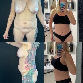 Before and after tummy tuck and liposuction results at Marroquín & Sandoval Plastic Surgery Clinic