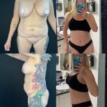 Before and after tummy tuck and liposuction results at Marroquín & Sandoval Plastic Surgery Clinic