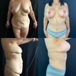 Before and after tummy tuck and liposuction results at Marroquín & Sandoval Plastic Surgery Clinic