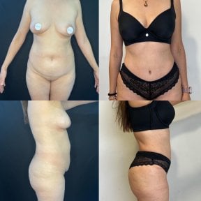 Before and after tummy tuck and liposuction results at Marroquín & Sandoval Plastic Surgery Clinic