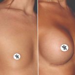 Vorher-nachher-Ergebnis der Mammoplastik im Private Yüzyıl Hospital, Brustvergrößerung