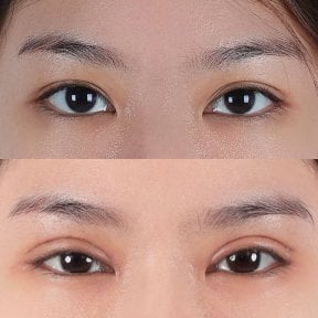 Результаты блефаропластики до и после, естественное улучшение век