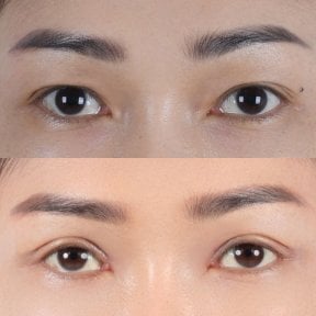 Resultados de blefaroplastia antes y después, corrección de párpados con aspecto natural