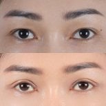 Resultados de blefaroplastia antes y después, corrección de párpados con aspecto natural