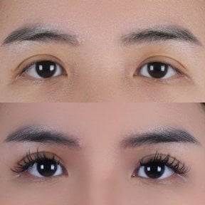 Resultados de blefaroplastia antes y después, corrección de párpados para ojos renovados
