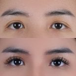 Resultados de blefaroplastia antes y después, corrección de párpados para ojos renovados