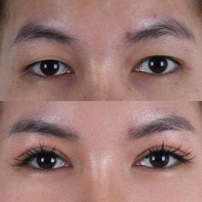 Resultados de blefaroplastia antes y después: corrección de párpados con aspecto natural