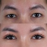 Resultados de blefaroplastia antes y después: corrección de párpados con aspecto natural