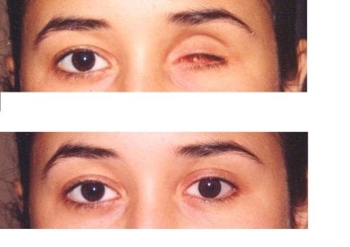 Before and after prosthetic eye results at Dunyagoz Eye Hospital Istanbul Atakoy
