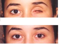 Before and after prosthetic eye results at Dunyagoz Eye Hospital Istanbul Atakoy