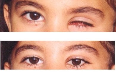 Before and after prosthetic eye results at Dunyagoz Eye Hospital Istanbul Atakoy, natural look