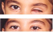Before and after prosthetic eye results at Dunyagoz Eye Hospital Istanbul Atakoy, natural look