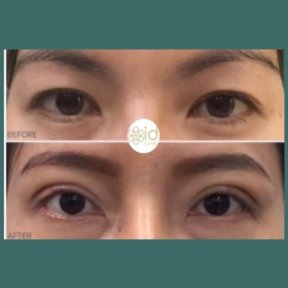 Before and after blepharoplasty results at ID Clinic Bangkok, eyelid correction improvement