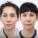 До и после уменьшения скул в Wansiri Hospital, видимый результат коррекции лица