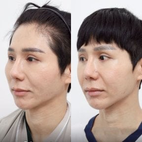 До и после уменьшения скул в Wansiri Hospital, видимое улучшение контура лица