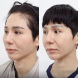До и после уменьшения скул в Wansiri Hospital, видимое улучшение контура лица