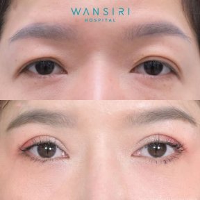 Before and after upper eyelid surgery results at Wansiri Hospital, brighter eye appearance