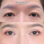 Before and after upper eyelid surgery results at Wansiri Hospital, brighter eye appearance