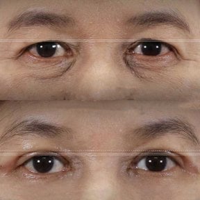 Before and after upper eyelid surgery results at Wansiri Hospital, eyelid lift improvement