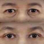 Before and after upper eyelid surgery results at Wansiri Hospital, eyelid lift improvement