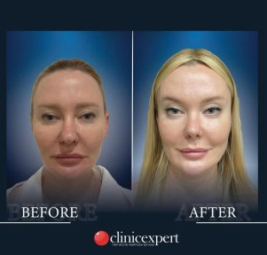 Before and after threads lifting result at CE International Hospital, facial rejuvenation visible