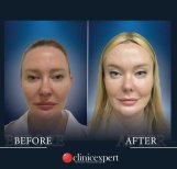 Before and after threads lifting result at CE International Hospital, facial rejuvenation visible