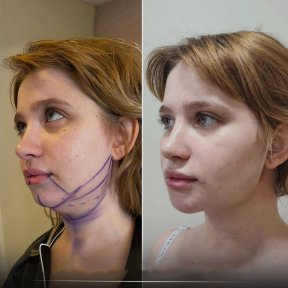 Before and after threads lifting result at CE International Hospital, improved jawline contour