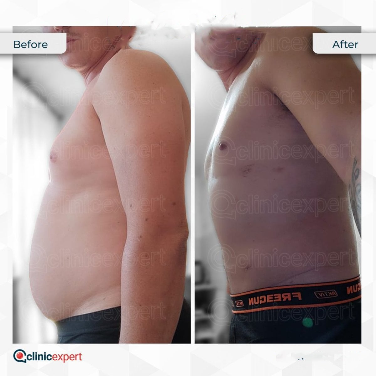 Resultado de liposucción de flancos antes y después en CE International Hospital, contorno corporal