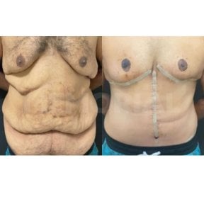 Результати абдомінопластики до і після в Memorial Bahçelievler Hospital, покращений контур живота