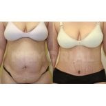 Результати до і після абдомінопластики в Memorial Bahçelievler Hospital, корекція живота