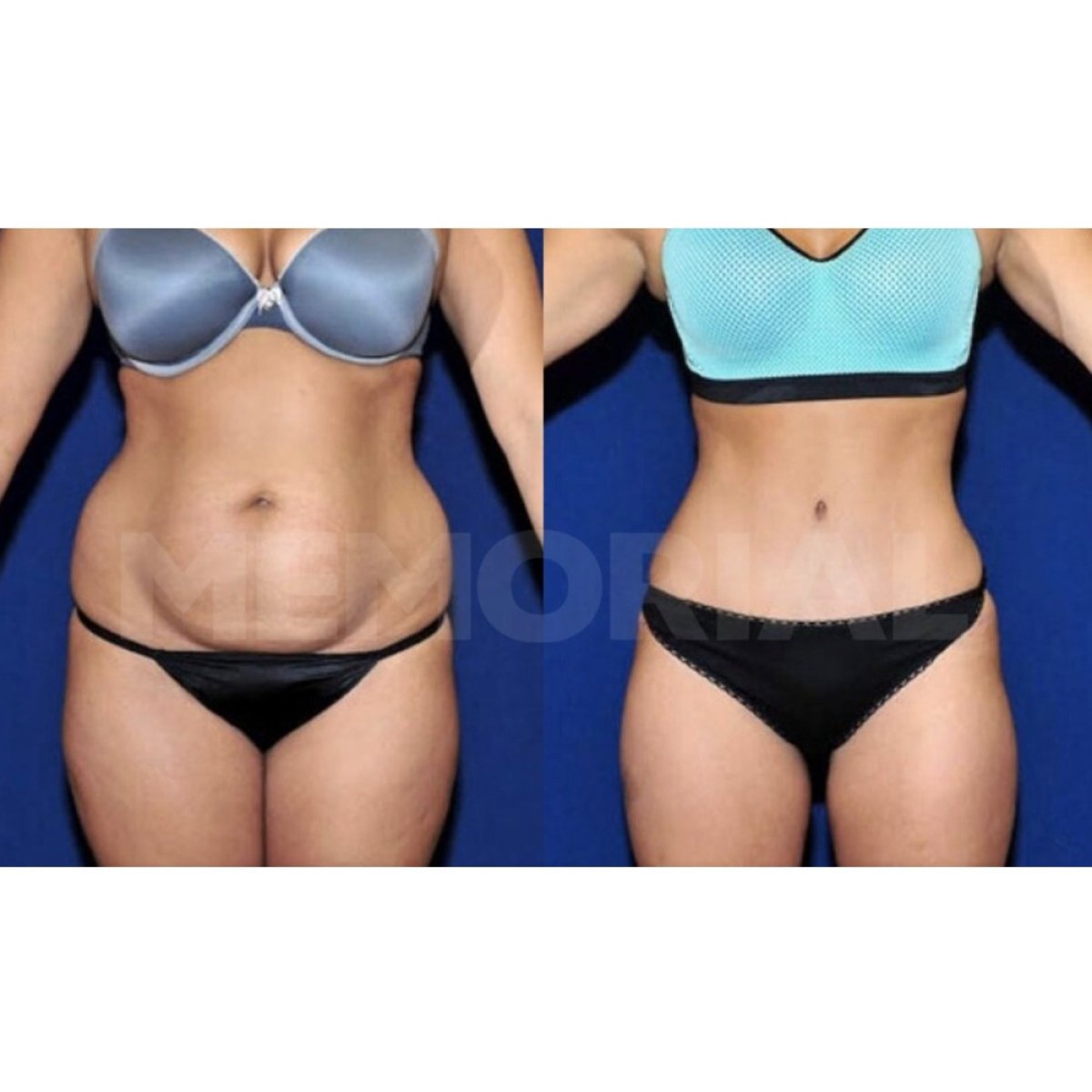Resultados de abdominoplastia antes y después en Memorial Bahçelievler Hospital, abdomen mejorado