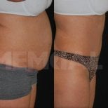 Результати абдомінопластики до і після в Memorial Bahçelievler Hospital, плоский живіт