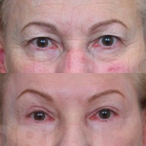 Before and after blepharoplasty results at Memorial Bahçelievler Hospital, eyelid correction
