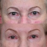 Before and after blepharoplasty results at Memorial Bahçelievler Hospital, eyelid correction
