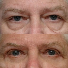 Before and after blepharoplasty results at Memorial Bahçelievler Hospital, eyelid correction