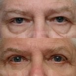 Before and after blepharoplasty results at Memorial Bahçelievler Hospital, eyelid correction