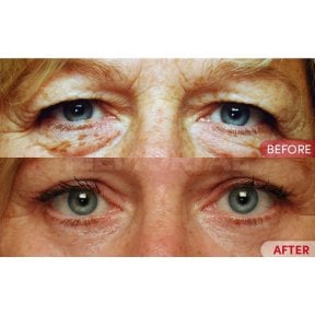 Before and after blepharoplasty results at Memorial Bahçelievler Hospital, eyelid correction
