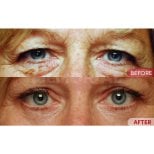 Before and after blepharoplasty results at Memorial Bahçelievler Hospital, eyelid correction
