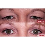 Before and after blepharoplasty results at Memorial Antalya Hospital, eyelid correction surgery