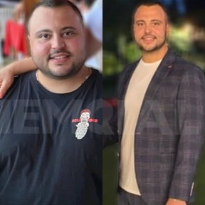 До и после гастрошунтирования в Memorial Ataşehir Hospital, видимый результат похудения