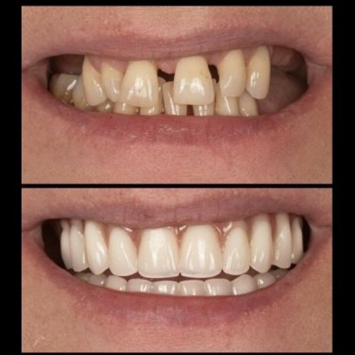نتائج قبل وبعد طقم الأسنان الهجين All-on-6 في HALDENT Dental Clinic، استعادة الابتسامة