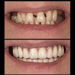 نتائج قبل وبعد طقم الأسنان الهجين All-on-6 في HALDENT Dental Clinic، استعادة الابتسامة