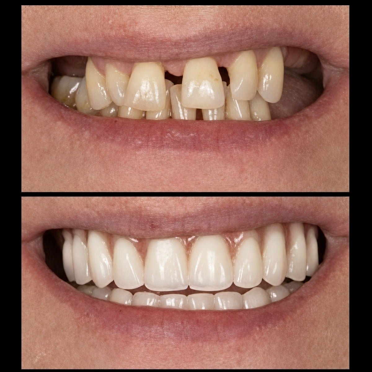 نتيجة قبل وبعد زراعة الأسنان All-on-6 في HALDENT Dental Clinic، استعادة الابتسامة