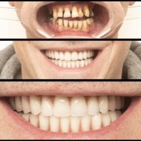 نتائج قبل وبعد طقم الأسنان الهجين All-on-6 في عيادة HALDENT، تحول الابتسامة